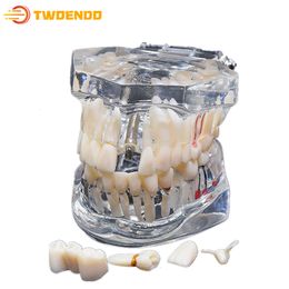 Autre modèle de dents consommables dentaires d'hygiène bucco-dentaire étudiant la maladie d'implant avec le modèle d'enseignement dentaire de dent de pont de restauration 230720
