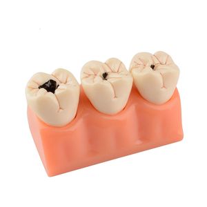 Andere orale hygiëne tandheelkundige rotten tanden model predure cariës ziekte tandmodel ontleding verval tandmodel tandarts leermiddelen 230815