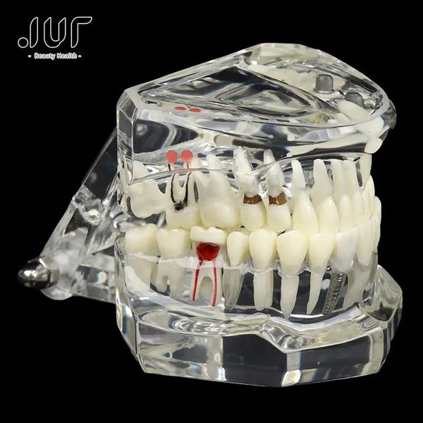 Autre modèle de dents de maladie d'implant dentaire d'hygiène bucco-dentaire pour l'enseignement de la science des soins de santé bucco-dentaire étude d'enseignement des maladies dentaires 231010
