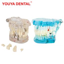 Andere orale hygiëne tandheelkundige implantaatmodel tandheelkunde tandartsziekte tandimplantaatmodel tanden met restauratiebrug voor medische wetenschapsonderwijs 230815