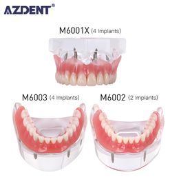 Otro modelo de enfermedad de dentaduras dentales de higiene oral de higiene de la dentadura postiza Modelo de dientes de la enfermedad con restauración Estudio de enseñanza 230425
