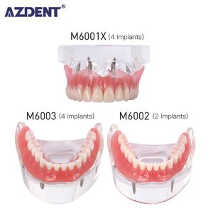 Andere orale hygiëne tandheelkundig implantaat verwijderbaar prothese Demo Disease Tanden Model met Restauratie Bridge Teaching Study 230425