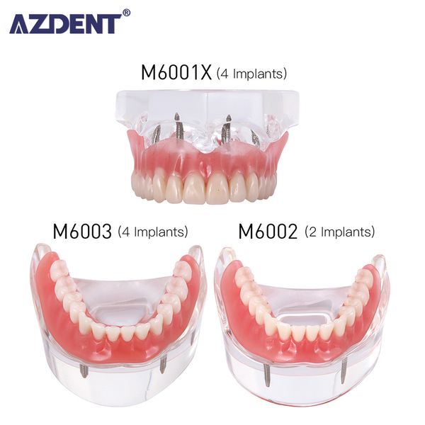 Autre modèle de dents de restauration d'implant dentaire d'hygiène bucco-dentaire Modèle de dent de démonstration de dentier de pont amovible Modèle de dents de maladie avec pont de restauration étude d'enseignement 230425