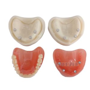 Magnetic Dental Study Model - Full Upper & Lower Denture with Mandibular Attachment for Oral Hygiene Education