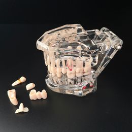 Andere Mondhygiëne Tandheelkundige Model Tanden Implantaat Restauratie Brug Onderwijs Studie Wetenschap Ziekte Tandarts Tandheelkunde Producten 230720