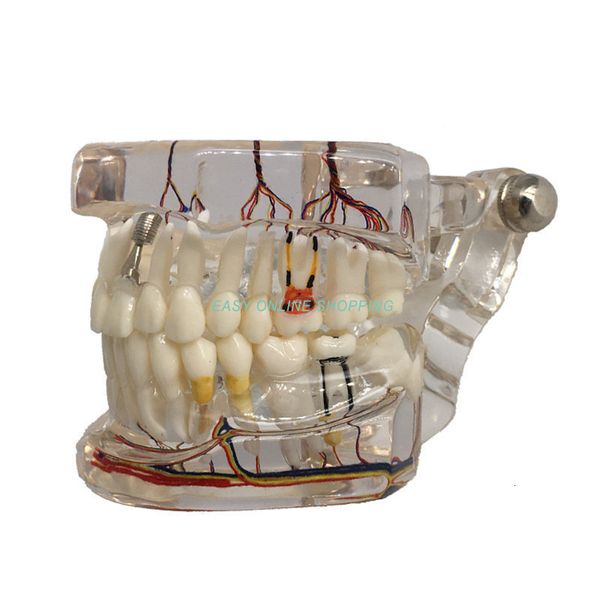 Autre modèle de dents d'enseignement dentaire d'hygiène bucco-dentaire avec modèle de démonstration d'enseignement de réparation pathologique transparent implanté de nerf modèle 230506
