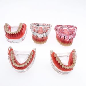 Andere mondhygiëne tandheelkundige tandenmodel met implantaten over -denture superieur demo -model voor student tandarts patiëntcommunicatiemodel 230815