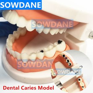 Andere orale hygiëne tandheelkundige tandmodel tanden model tandcariës model voor patiëntcommunicatie tandarts studiemodel met vervallen tand 230815
