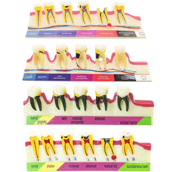 Autre hygiène buccale dents modèle de maladie parodontale affichage de la panne des caries dentaires spectacle de parodontite enseignement modèle de dent dentiste Communication 230516