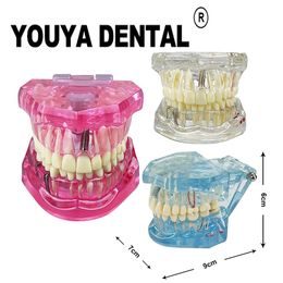 Autre maladie du modèle de réparation des dents d'hygiène buccale pour la formation des élèves dentiste Formation de la pratique de la dentisterie 230704