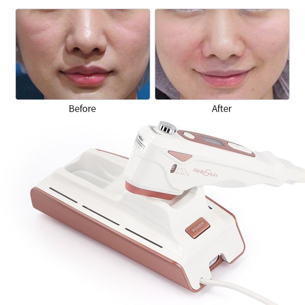 Portable Mini Hifu machine lifting visage Raffermissement de la peau Soins de la peau HIFU thérapie par ultrasons focalisés de haute intensité HIFU Beauty Machine