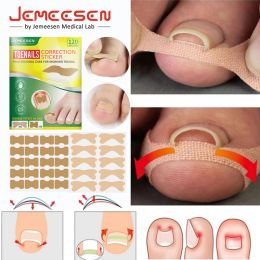 Outil Jemeesen Patch correcteur d'ongle incarné autocollants de Correction d'ongle traitement Paronychia orteil pouce patchs de soin des ongles 120 pièces