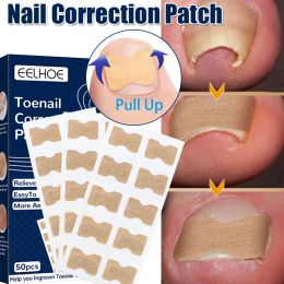 Traitements 50pcs Correction des ongles Autocollants INGROWN TOENNAIL PARONYCHIA Traitement Correcteur Impermétroores élastiques Élastiques Patches indolores Outils de pédicure