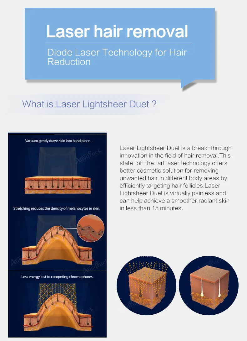 Lumenis Lightsheer Duet Vs Alexandrite Shelly Lighting