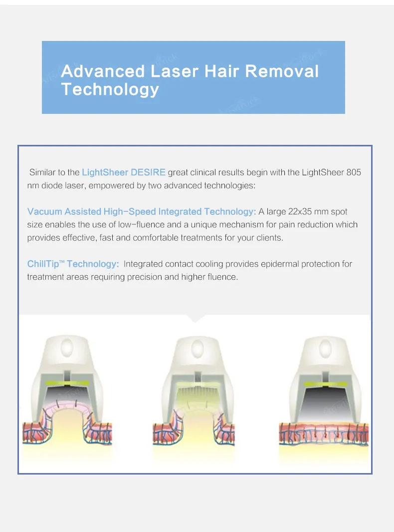 HS ET 808nm/810nm Diode Laser Cynosure Laser Hair Removal System High