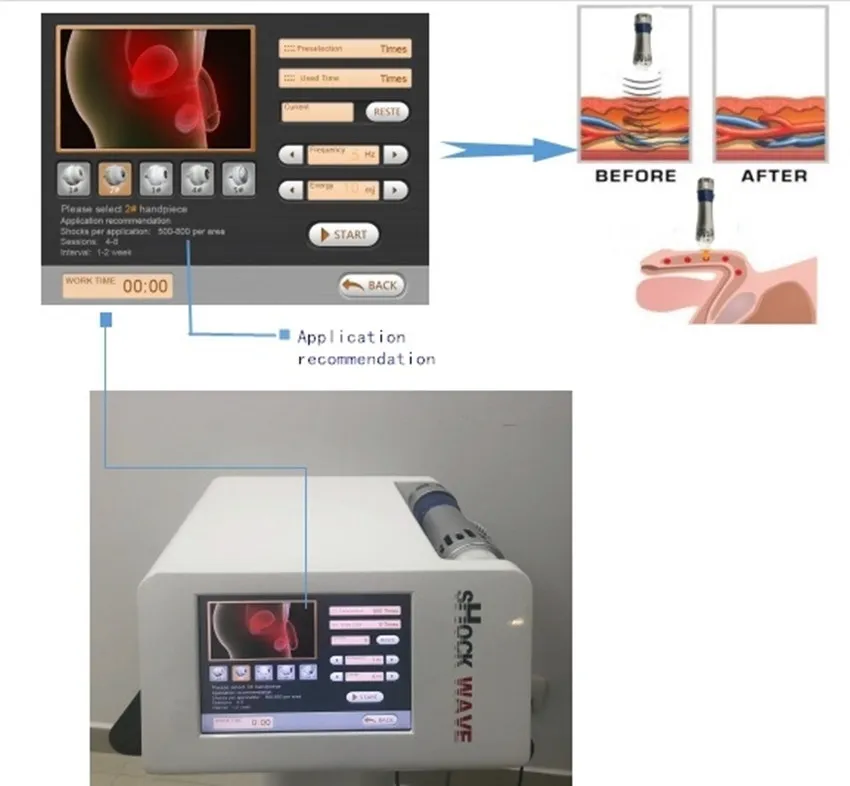 Home Use Electromagnetic ESWT Extracorporeal Shock Wave Pain Relief Erectile Dysfunction Machine For ED Treatment Physiotherapy Health Care Equipment Electromagnetic extracorporeal shock wave machine for ed - Honkay shockwave therapy machine,shockwave therapy machine for ed,shock wave therapy device,shock wave machine,shock wave