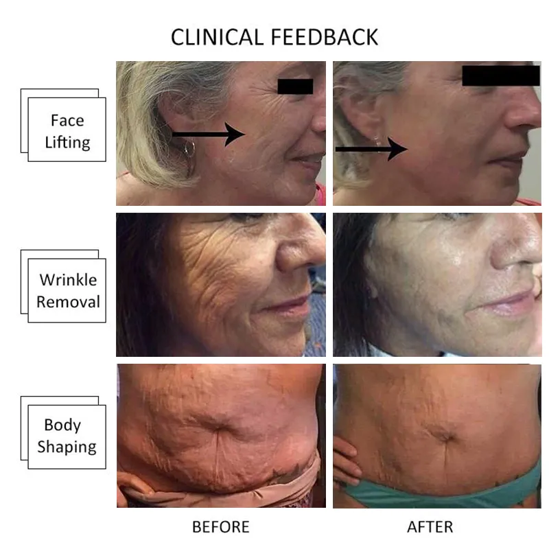 Beste HIFU-Faltenentfernung Ultraschall-Laser-HIFU-Facelift-Ausrüstung HIFU-Hautstraffungsmaschinen kostenloser Versand