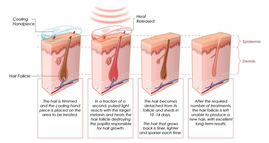 micro-channel laser diode 808 hair removal