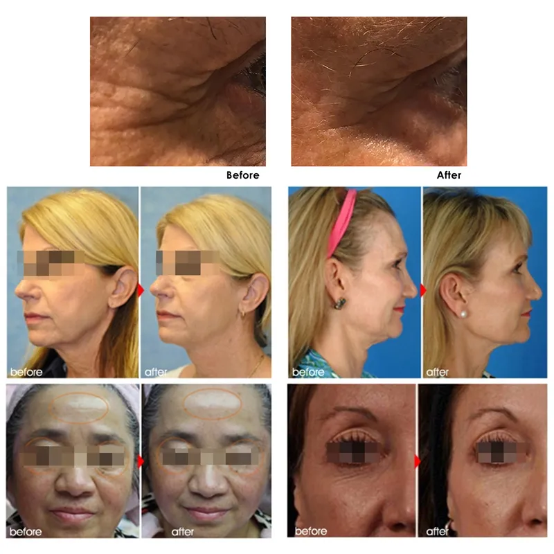 3D هيفو آلة الجسم التخسيس الجلد تشديد عالية الكثافة التركيز الموجات فوق الصوتية الوجه رفع معدات الجمال