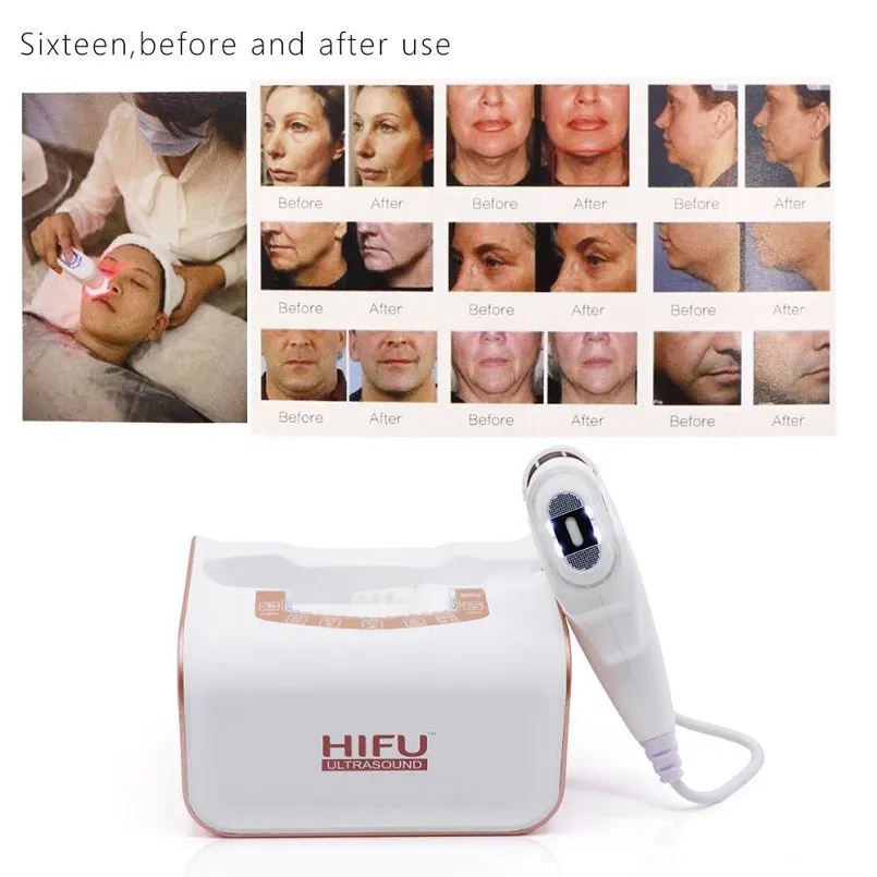 2021 Ev Mini HIFU Professional Yüz Gençleştirme Anti-Aging Kırışıklık Taşınabilir Odaklı Radyo Frekans Güzellik Enstrüman