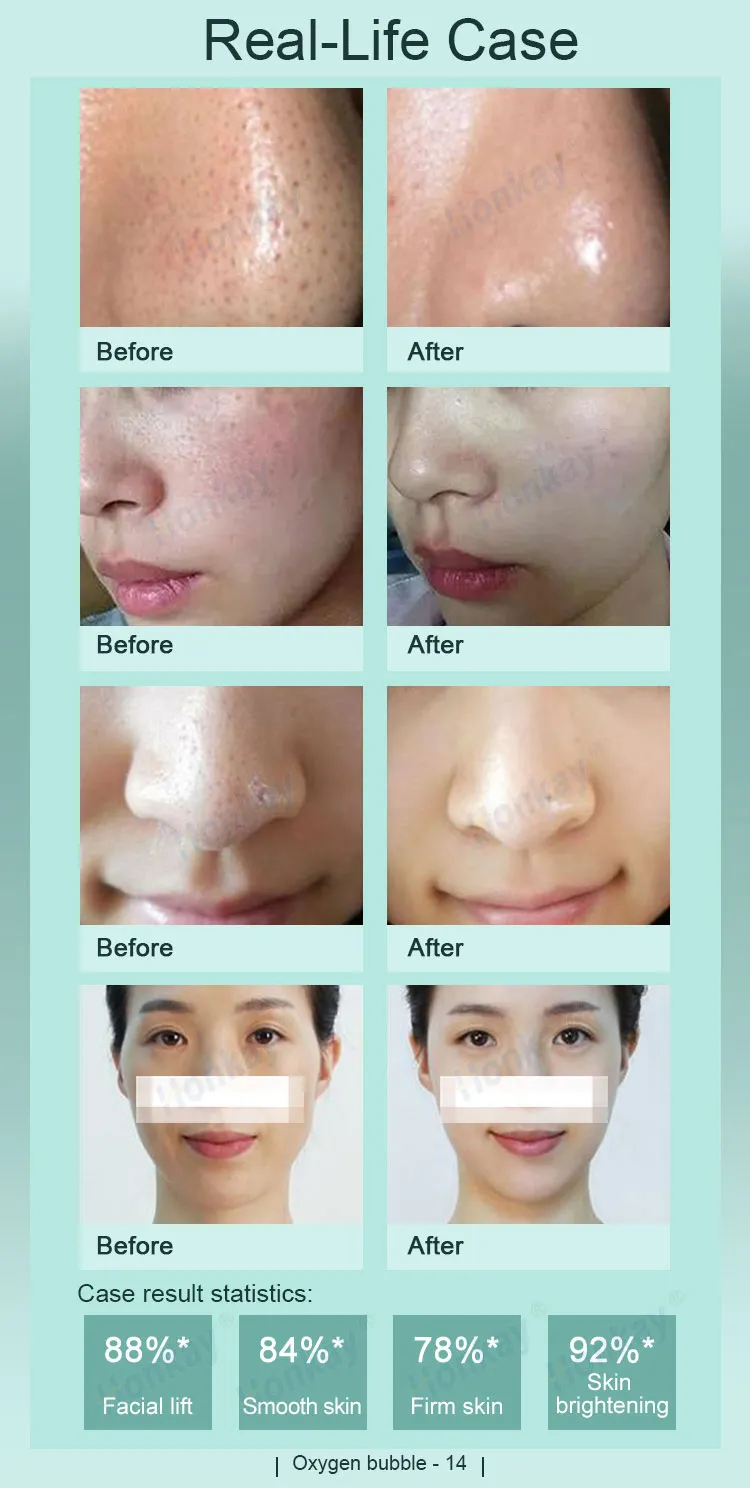 Portable 8 In 1 Oxygen Bubble Skin Comprehensive Water Dermabrasion