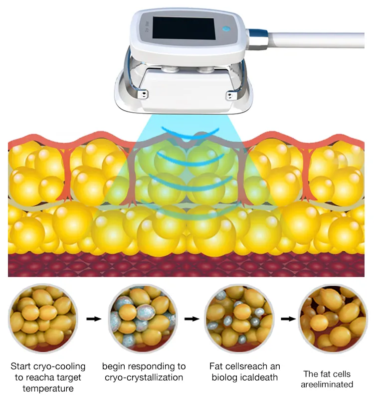 Cryolipolysis weight loss machine weight loss and slimming professional machine fat freeze cryolipolysis machine