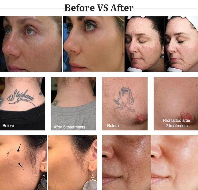 Professional Pico Picosecond Laser Machine Lazer Tattoo Removal 755nm Cynosure Freckle Spot Pigmentation Melasma Acne Treatment