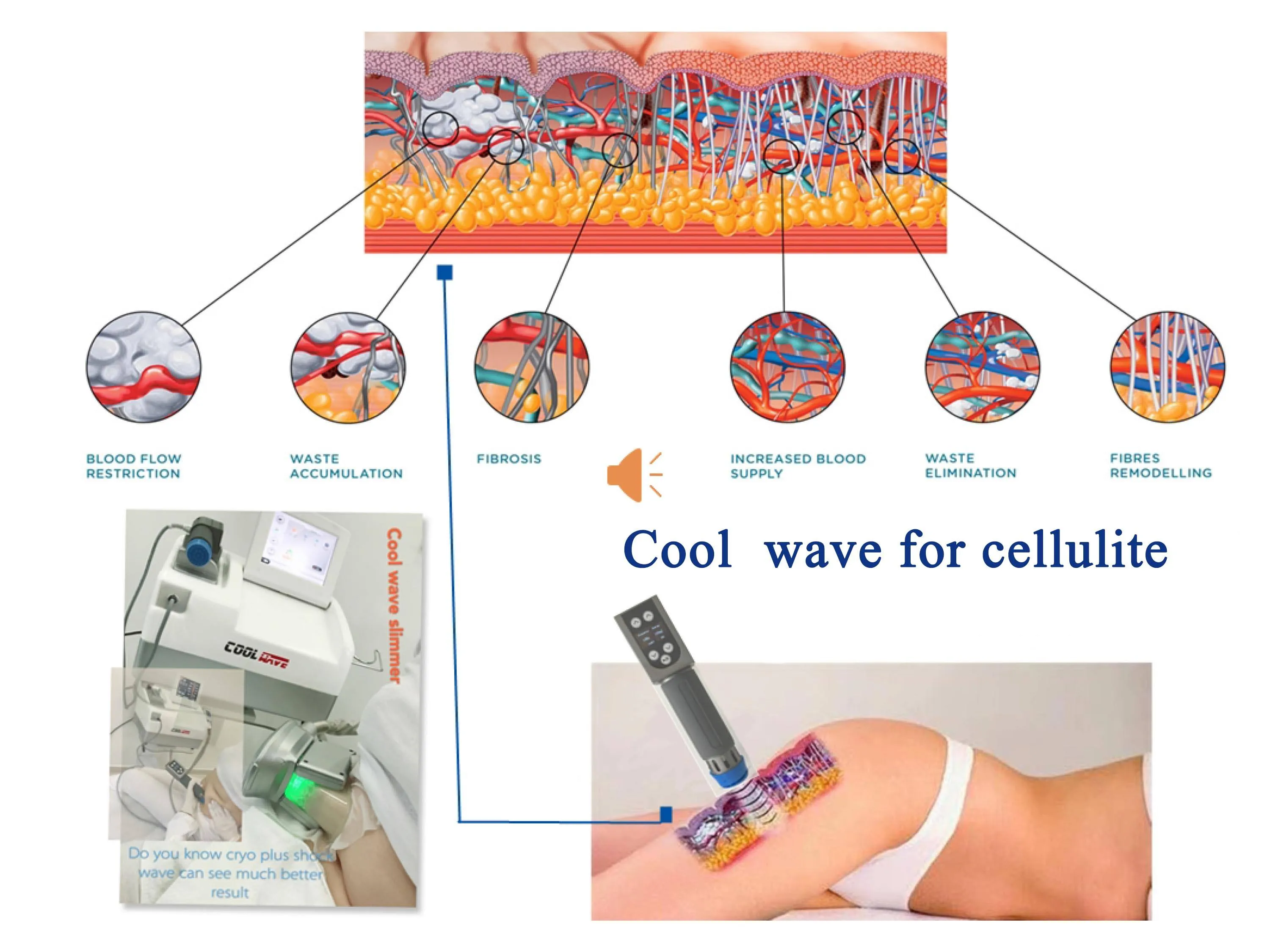 German cool criolipolisys machine freeze fat shockwave cryo therapy machine