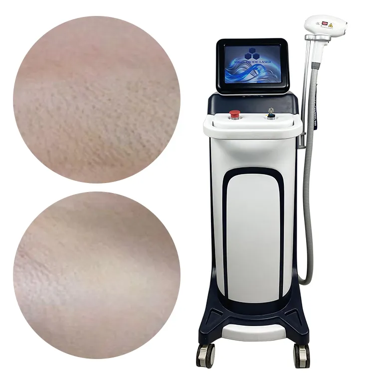Permanent Hair loss Machine Fast 755 808 1064nm Diode Pico Laser Permanent Laser Hair Tattoo Removal Machine Hair Removal for woman