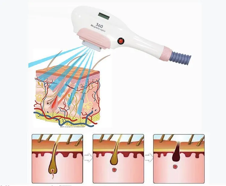 ipl rf nd yag laser