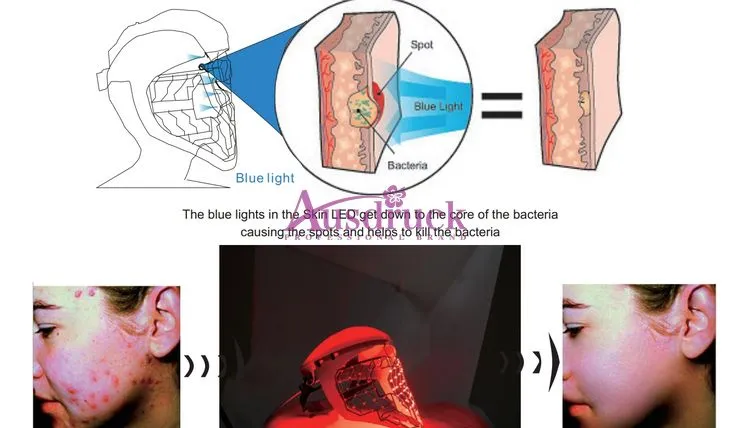 뜨거운 판매 광양자 전기 반대로 주름 여드름 제거 얼굴 피부 회춘 아름다움기구