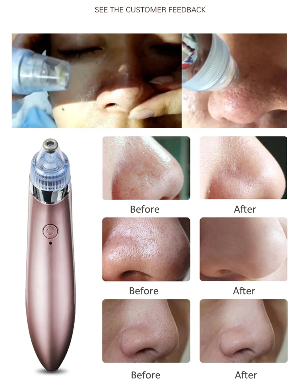 Laddningsbar Blackhead Remover Vakuum Ansiktrengöring Svarta prickar Sug Exfolierande skönhet Acne Pimple Remover Tool Skin Care