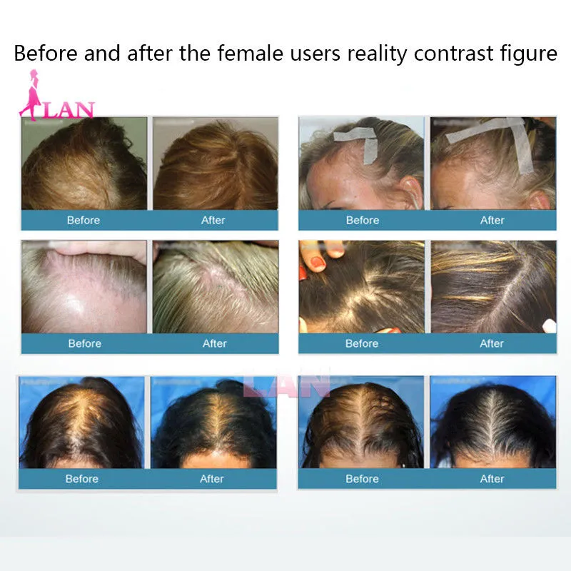 Laser Hair Growth Comb, Infrared Stimulator For Hair Loss Prevention