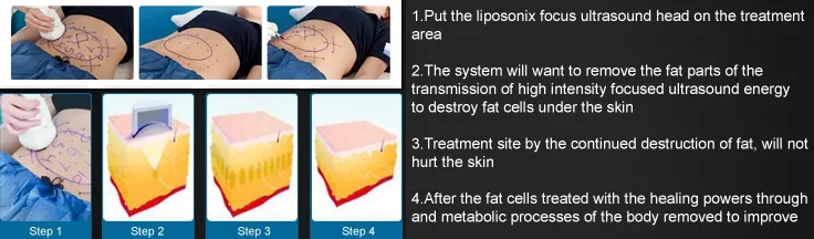 UltraShape Liposonix Real Medical Grade Liposonix Hifu Lipohifu Machine med 13mm 8mm liposonic liposonix patroner för snabb kroppsform