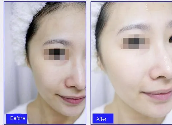 바늘 무료 Mesotherapy 주입 건 스킨 케어 주름 제거를위한 메소 건 스킨 레 쥬 베 네이션 주입 건