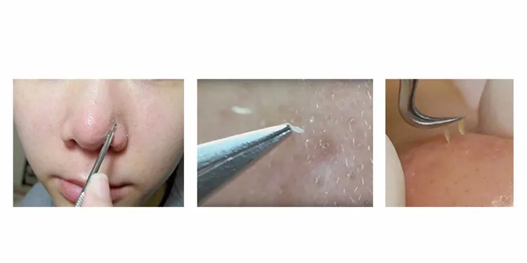 Blackhead Shemish Acné Pimple Extracteur Tool Retracteur Set Tool Face Care Skin Twezer en acier inoxydable Aignedle Kit8972338