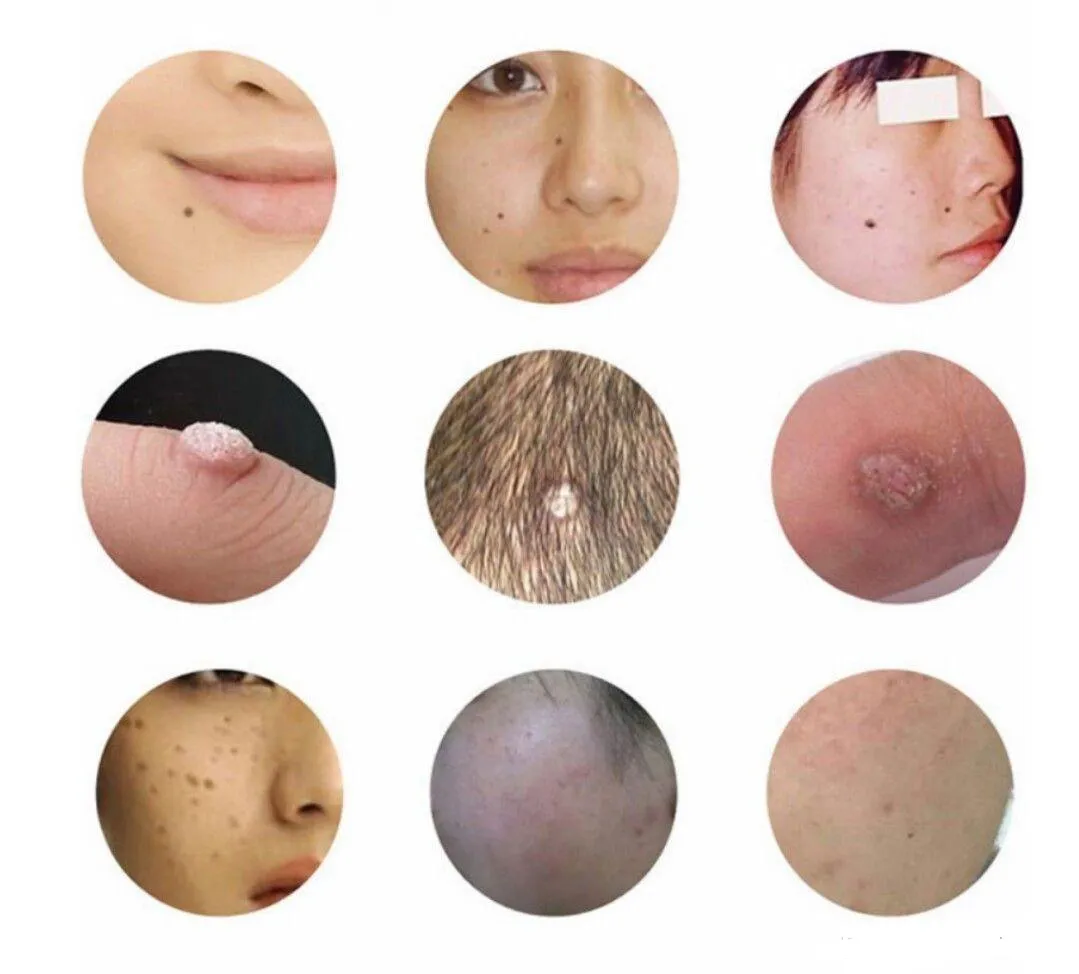 Dark Spot Wart Tattoo Mole Remover Usunięcie Pielęgnacja skóry Piękno Urządzenie laserowe Akumulator Przenośny Strona główna Użyj dostaw makijażu