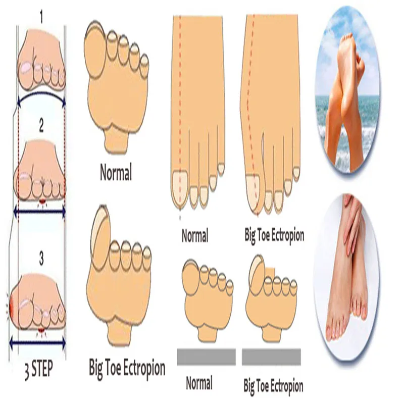 하이힐 실리콘 발 관리 도구 깔창 정형용 아저씨 페디큐어 피트 케어 외반 모지 교정기 발가락 분리기