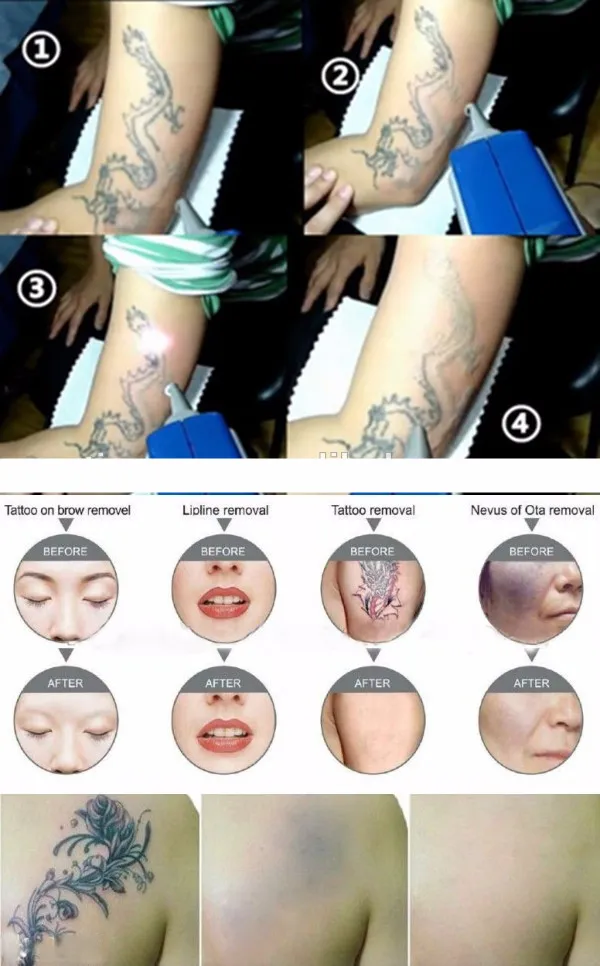 Q SWTICH YAG Laserowy Maszyna do usuwania tatuażu All Color Tattoo Demontain Laser Machine