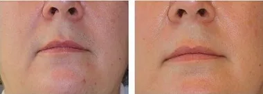 Depilazione Permanente Con Laser Depilazione Permanente Diodo Laser Spa Clinica Salone Di Bellezza Macchina Prezzo