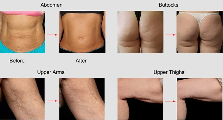 Profissional 5 em 1 cavitação de ultrassonografia RF radiofrequência bipolar tripolar 8 polar cavitação de RF para rosto e corpo