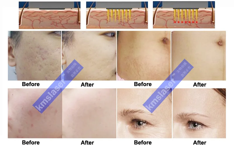 Удаление растягивающих меток Удаление кожи Омоложение RF Фракционная микроигольчатая радиочастотная машина для ухода за лицом