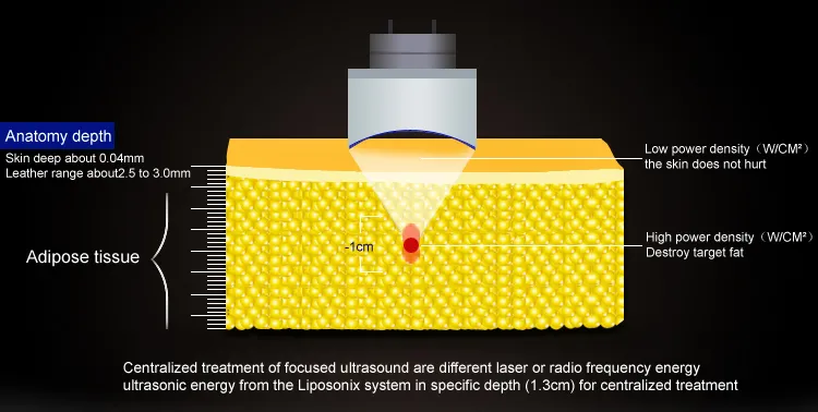 Liposonix médico de alta intensidade de alta intensidade Focada Máquina de emagrecimento de Hifu com cartucho de 8 mm de 13 mm para perda de peso de emagrecimento corporal