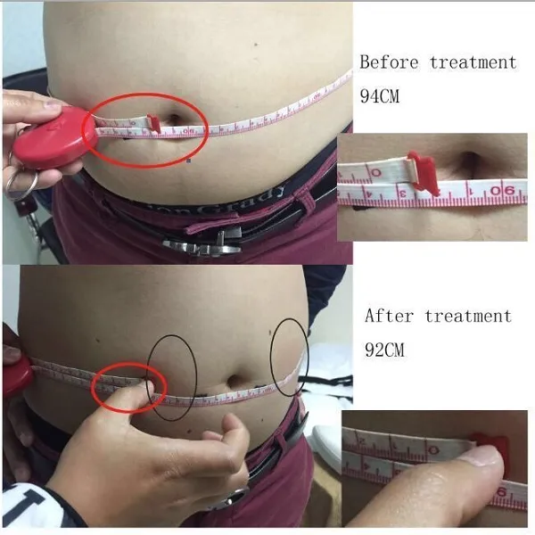 Yeni kaplıca kliniği yeni tam vücut zayıflama HIFU liposonix anti selülit lipo HIFU HIFU makine