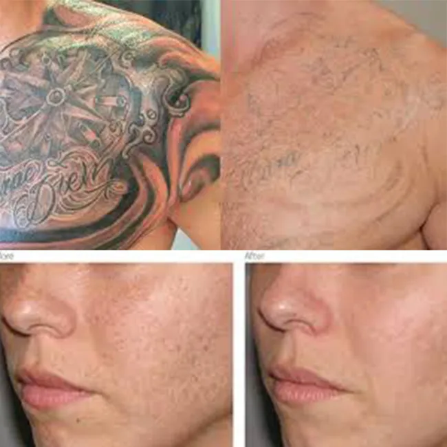 Выведение татуировок лазером. Лазерная дермабразия розацеа. Шлифовка лица лазером со2 реабилитация. Лазерное сведение тату. Как выглядит кожа после лазера.