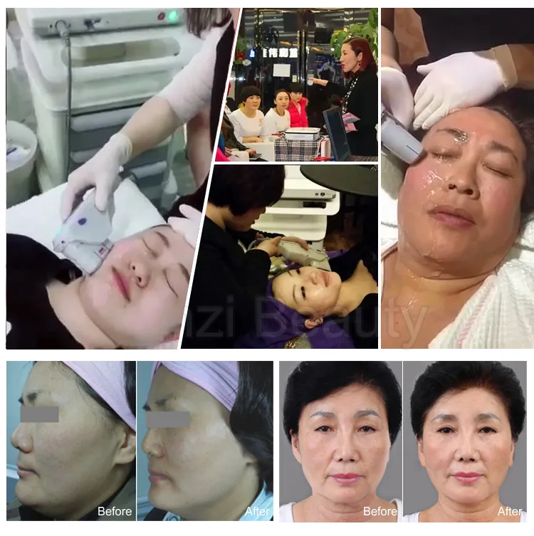 Beauty salon popular hifu face lift device face lift machine wrinkle removal