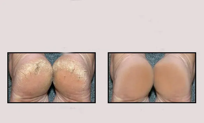 Skarpety do pielęgnacji stóp silikonowe nawilżające żel szpilki skarpetki Pęknięta stopa Pielęgnacja skóry Ochraniacze Anti Cracking