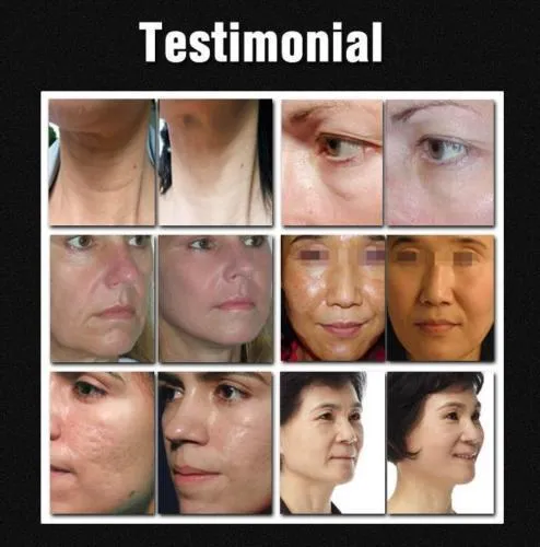 Intelligent Fractional Beauty Radio Frequency Face Lift Skin Tightening Wrinkle Removal Dot Matrix RF Machine DHL