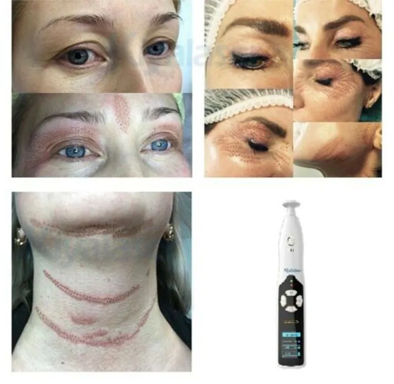 Nyaste Fibroblast Portable Plasma Pen Eyelock Lifting PlasmaPen Anti Wrinkle Hudvård Åtstramande Fläckfläckborttagningsmedel Skönhetsmaskin DHL