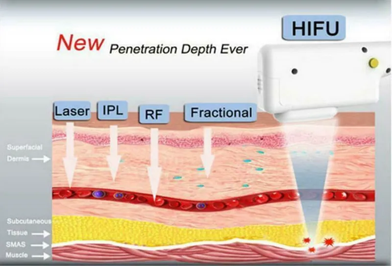 Profesyonel HIFU Yüksek Yoğunluklu Odaklı Ultrason Facelift Kırışıklık Temizleme Yüz ve Gövde için Yaşlanma Karşıtı Cilt Sıkma Zayıflama Makinesi